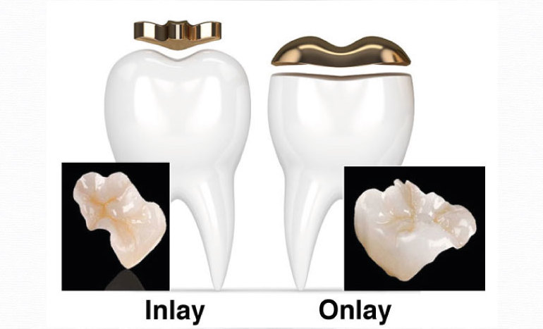 uzupełnienia zębów inlay i onlay