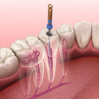 zabieg endodoncji